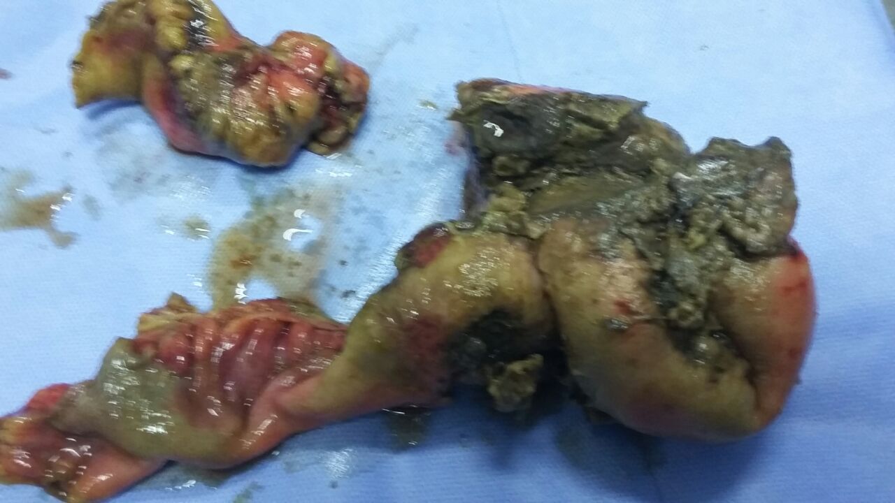 Post Appendectomy Intestinal Obstruction